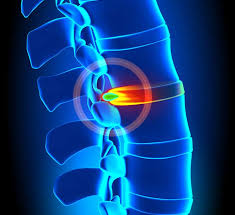 Back Pain - Physiotherapy Nelson Bay
